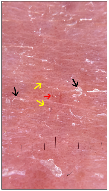 Dermoscopy of the leg lesion observed a homogeneous dull‐red background, dotted (yellow arrow) and hairpin (red arrow) vessels with white scales (black arrow) on the left lower limb (polarising, 10x)